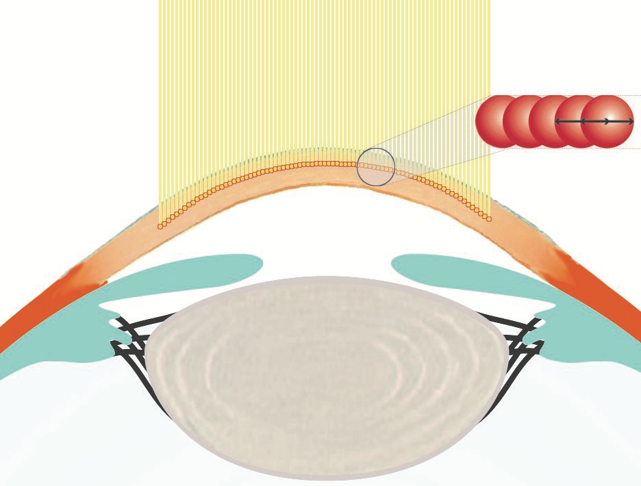 Femtosekundenlaser