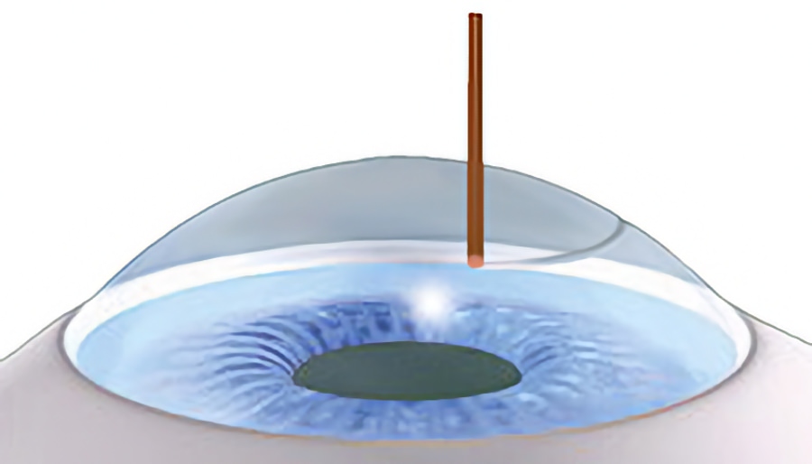 Femtosekundenlaser