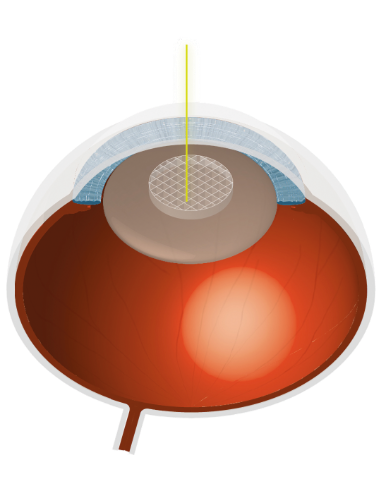 Grauer Star Illustration Auge
