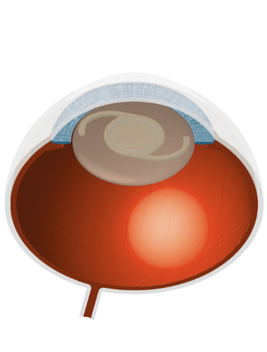 Grauer Star Illustration Auge